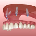 The Importance of Placement of Implants in the Denture Implant Procedure