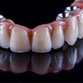 Understanding X-rays and Scans: A Comprehensive Guide for Denture Implant Procedures