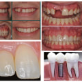 How Traditional Partial Dentures Can Give You a Beautiful Smile