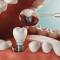 Exploring Your Options for Denture Implants