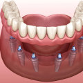 How Implant-Supported Complete Dentures Can Restore Your Smile
