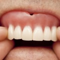 Adjusting to Wearing Dentures: What You Need to Know