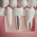 A Guide to Abutment Placement in Denture Implant Procedures