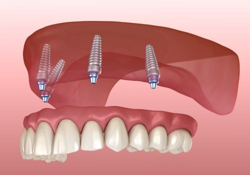 The Importance of Placement of Implants in the Denture Implant Procedure
