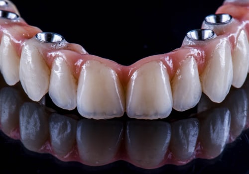 Understanding X-rays and Scans: A Comprehensive Guide for Denture Implant Procedures