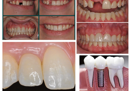 How Traditional Partial Dentures Can Give You a Beautiful Smile