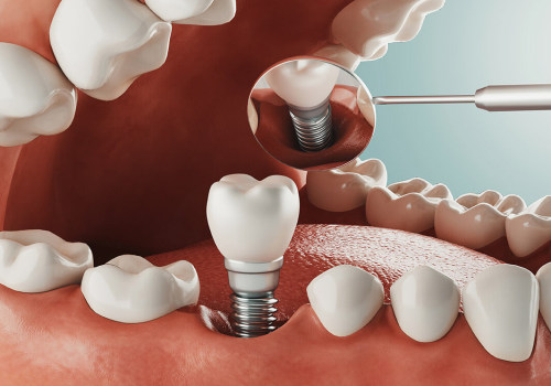 Exploring Your Options for Denture Implants