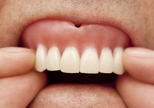 Adjusting to Wearing Dentures: What You Need to Know