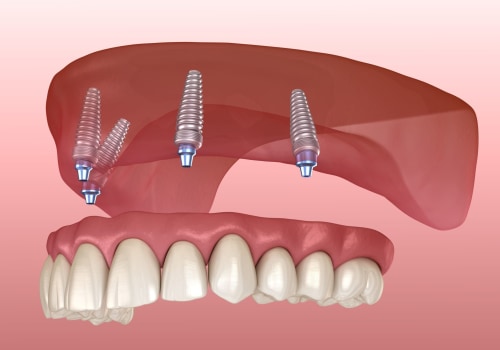 The Importance of Adjustments and Fittings in the Denture Implant Procedure