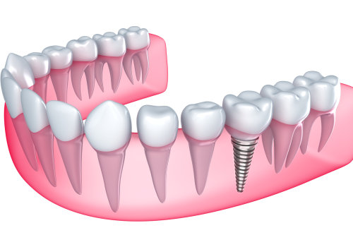 Understanding the Healing Period After a Denture Implant Procedure